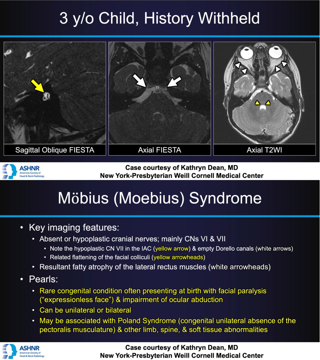 ASHNR (@ashnrsociety) on Twitter photo #ASHNRCOTW #140 ANSWER: Moebius syndrome! Thx Dr. <a href="/KateEDean/">Katie Dean</a> 4 case! #ASHNR21
<a href="/IlonaSchmalfuss/">Ilona Schmalfuss</a> <a href="/callyrobs/">Caroline Robson, MBChB</a> <a href="/DShatzkes/">Deborah Shatzkes</a> <a href="/CDP_Rad/">C Douglas Phillips 🇺🇸</a> <a href="/rhwiggins/">Richard Wiggins</a> <a href="/nakoontz/">Nicholas Koontz</a> <a href="/cmtomblinson/">Courtney Tomblinson, MD</a> @CincyPedsNeuro <a href="/sineadculleton/">Sinéad Culleton MB,BCh,BAO 🇮🇪</a> <a href="/ESHNRSociety/">ESHNR</a> <a href="/TheASNR/">The American Society of Neuroradiology</a> @SPRneuro <a href="/RadRupa/">Rupa Radhakrishnan</a> <a href="/AnnJayMD1/">Ann Jay MD</a> <a href="/CMGlastonbury/">Christine M Glastonbury, MD</a> <a href="/PhilipRChapman1/">Philip R. Chapman, MD</a> #ASHNRCOTW #140 ANSWER: Moebius syndrome! Thx Dr. <a href="/KateEDean/">Katie Dean</a> 4 case! #ASHNR21
<a href="/IlonaSchmalfuss/">Ilona Schmalfuss</a> <a href="/callyrobs/">Caroline Robson, MBChB</a> <a href="/DShatzkes/">Deborah Shatzkes</a> <a href="/CDP_Rad/">C Douglas Phillips 🇺🇸</a> <a href="/rhwiggins/">Richard Wiggins</a> <a href="/nakoontz/">Nicholas Koontz</a> <a href="/cmtomblinson/">Courtney Tomblinson, MD</a> @CincyPedsNeuro <a href="/sineadculleton/">Sinéad Culleton MB,BCh,BAO 🇮🇪</a> <a href="/ESHNRSociety/">ESHNR</a> <a href="/TheASNR/">The American Society of Neuroradiology</a> @SPRneuro <a href="/RadRupa/">Rupa Radhakrishnan</a> <a href="/AnnJayMD1/">Ann Jay MD</a> <a href="/CMGlastonbury/">Christine M Glastonbury, MD</a> <a href="/PhilipRChapman1/">Philip R. Chapman, MD</a>