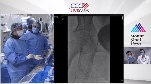 ccclivecases's tweet photo. We're LIVE now! Ask us your questions @PK_MountSinai
https://t.co/lLZG6WvdPN
"MANAGEMENT OF SFA IN-STENT RESTENOSIS"
#peripheral #livecase #sfa #instentrestenosis #ccclivecases #mountsinaihospital #endovascular https://t.co/NShNmbexTp