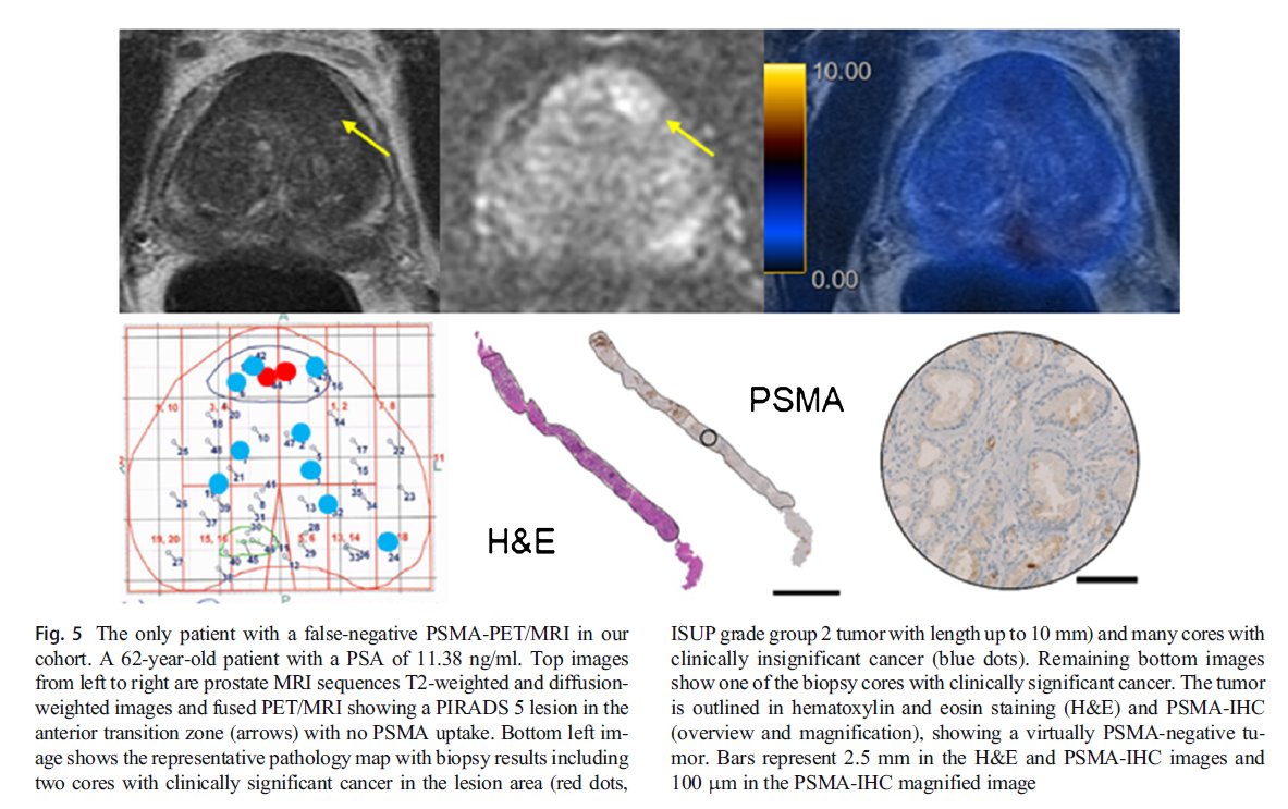 Diagnostic performance of 68Ga-PSMA-11 PET/MRI-guided biopsy in patients with suspected #prostatecancer: a prospective single-center study link.springer.com/article/10.100… 
"very nice study, congrats to Authors 👍 figure 5 is very interesting, we need to see more such work" #MedTwitter