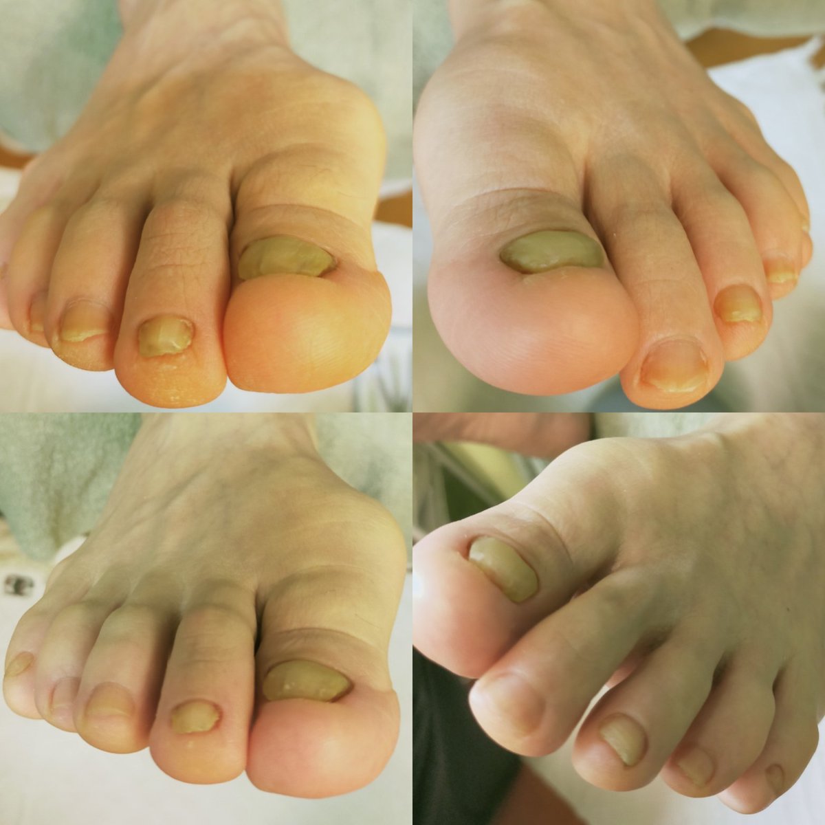 かたい爪 かたい爪