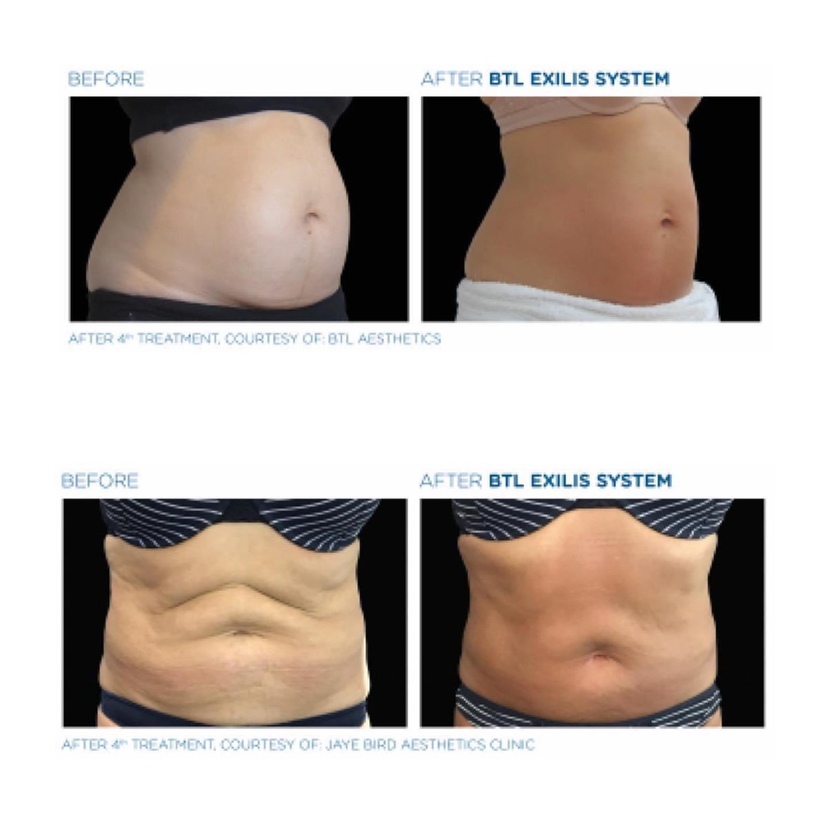 SkinAesthetica's tweet photo. Body Positivity @aestheticaskincentre @btlaestheticssouthafrica #skin2go #skinlovers #bodypositivity #bodycontouring #btlaesthetics https://t.co/bSxYvyFD8Z