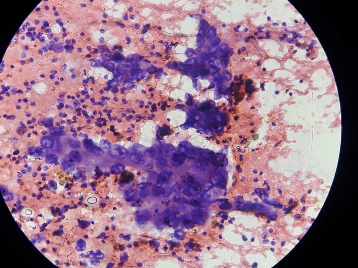 Sukumar40738920's tweet photo. F/55yo. Axillary mass aspirate. Your dx? https://t.co/pA2eUXCGve