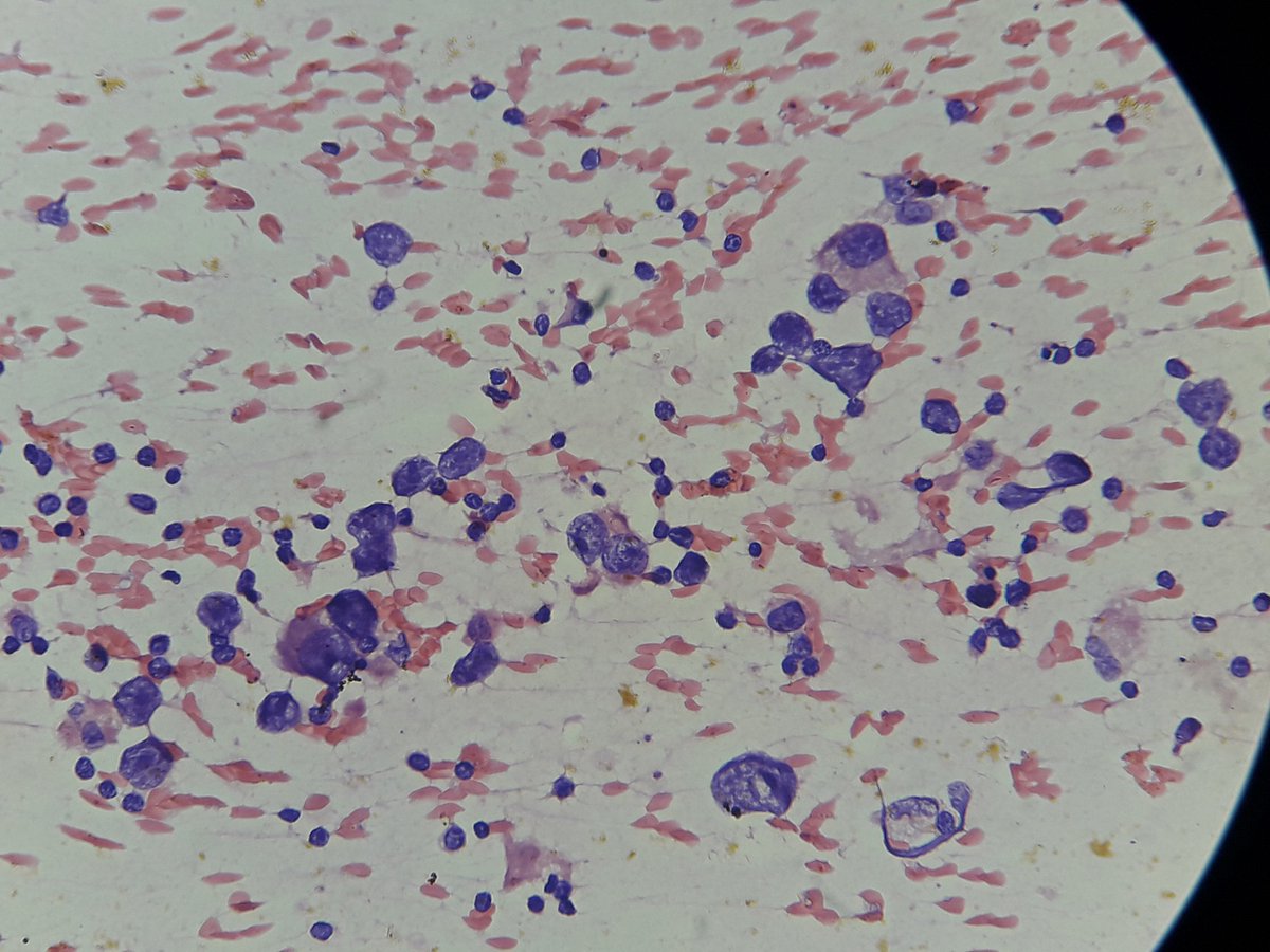 Sukumar40738920's tweet photo. F/55yo. Axillary mass aspirate. Your dx? https://t.co/pA2eUXCGve
