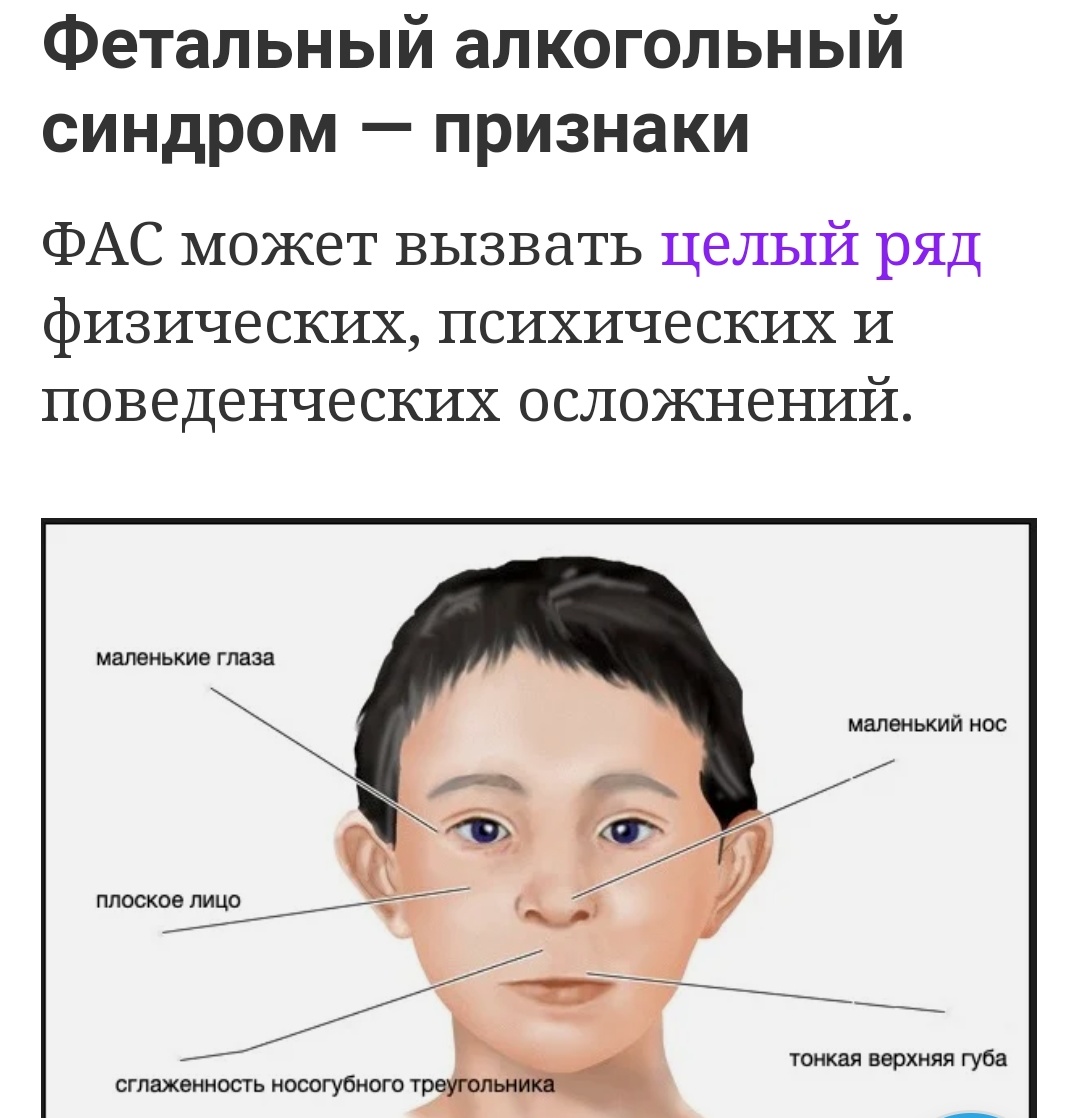 Признаки фетального алкогольного