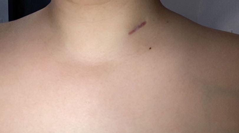 chloe_lavenir's tweet photo. Après des mois de combat et un dernier scanner je peux enfin dire que j’ai été plus forte que ce fichu CANCER !! 💪🏼 Tout ça n’est plus qu’un mauvais souvenir maintenant, fini les chimio, les médicaments et les séjours à l’hôpital 🎉🎉❤️ https://t.co/zzHgwbRUxZ
