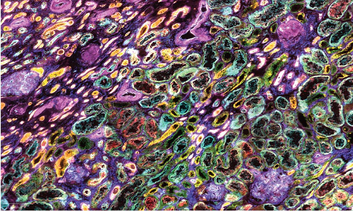 Human BioMolecular Atlas Program (HuBMAP) (@_hubmap) on Twitter photo Itās time for <a href="/_hubmap/">Human BioMolecular Atlas Program (HuBMAP)</a>ās image of the week! Dr. Elizabeth Neuman of @capriolilab @vanderbiltuās Tissue Mapping Center has made a CODEX MIF of a human kidney cortex that highlights 7 different types of cells. #womeninscience #immunofluorescence #scienceimage Itās time for <a href="/_hubmap/">Human BioMolecular Atlas Program (HuBMAP)</a>ās image of the week! Dr. Elizabeth Neuman of @capriolilab @vanderbiltuās Tissue Mapping Center has made a CODEX MIF of a human kidney cortex that highlights 7 different types of cells. #womeninscience #immunofluorescence #scienceimage