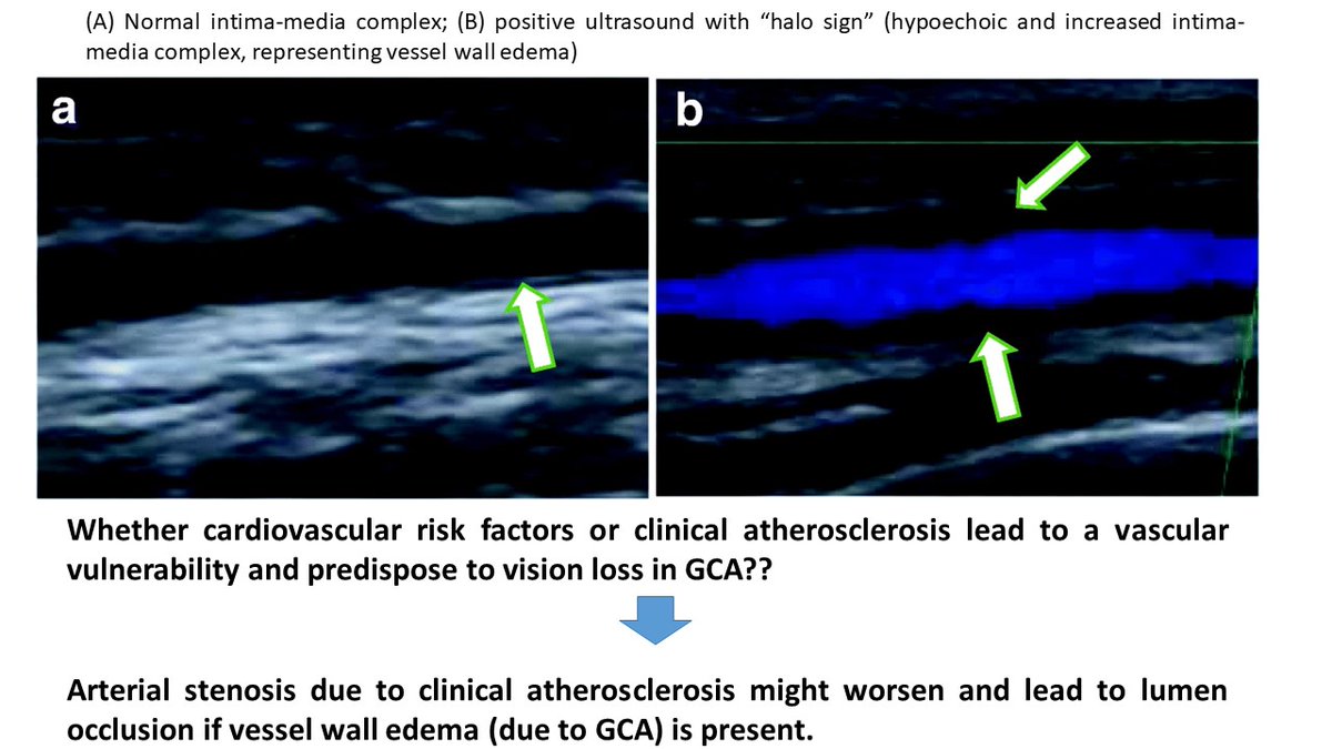 A NEW study found that #GiantCellArteritis patients with visual manifestations at presentation have more baseline vascular risk factors 📌diabetes, 📌atherosclerosis than patients without ocular involvement.
👉rdcu.be/cfn0z
