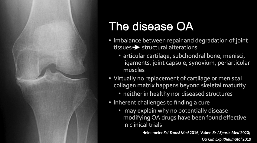 4/ As far as the disease is concerned, we DO NOT have a cure & there are inherent challenges to finding one. Some challenges may be very difficult to overcome. Despite that, efforts to find a cure for  #OA are important & should continue 