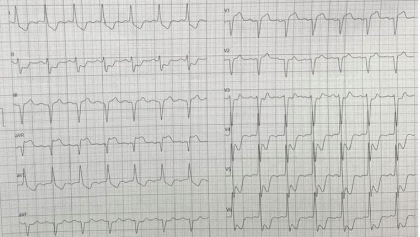 #electrodesafio Masculino de 56 años,  con dolor precordial opresivo irradiado a miembro sup izq, ingresa en regulares condiciones, TA 80/50 mmHg,  con el ECG que se muestra a continuación. Cual sería el diagnóstico mas preciso y qué conducta tomarías?