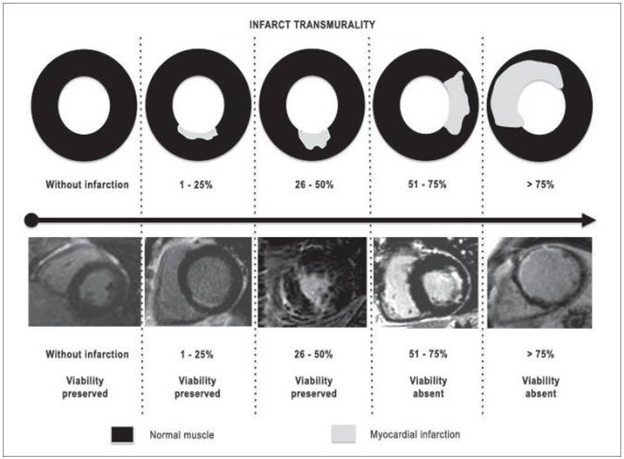 In summary (cont.): There are numerous imaging modalities available for the evaluation of  viability. FDG-PET and CMR +/- Dobutamine Stress are the most sensitive and specific (the attached graphic shows CMR LGE assessment of infarct transmurality)