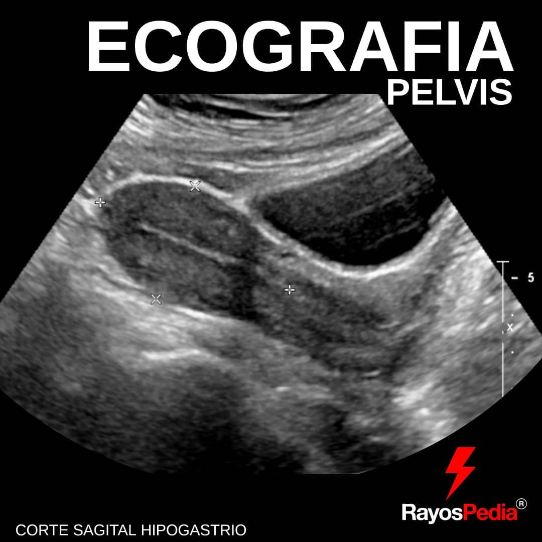 rayospedia's tweet photo. Ecografía pélvica corte sagital! https://t.co/yOAcomRtXm