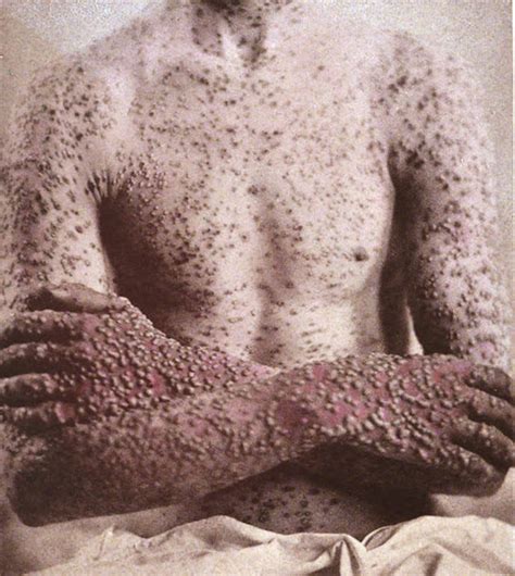 Contohnya macam virus cacar atau smallpox, yang genomnya terdiri daripada DNA.Cacar sangat mudah merebak dan menyebabkan kematian yang tinggi. Tetapi setelah vaksin dibangunkan, wabak cacar telah berhasil dibasmi sepenuhnya.