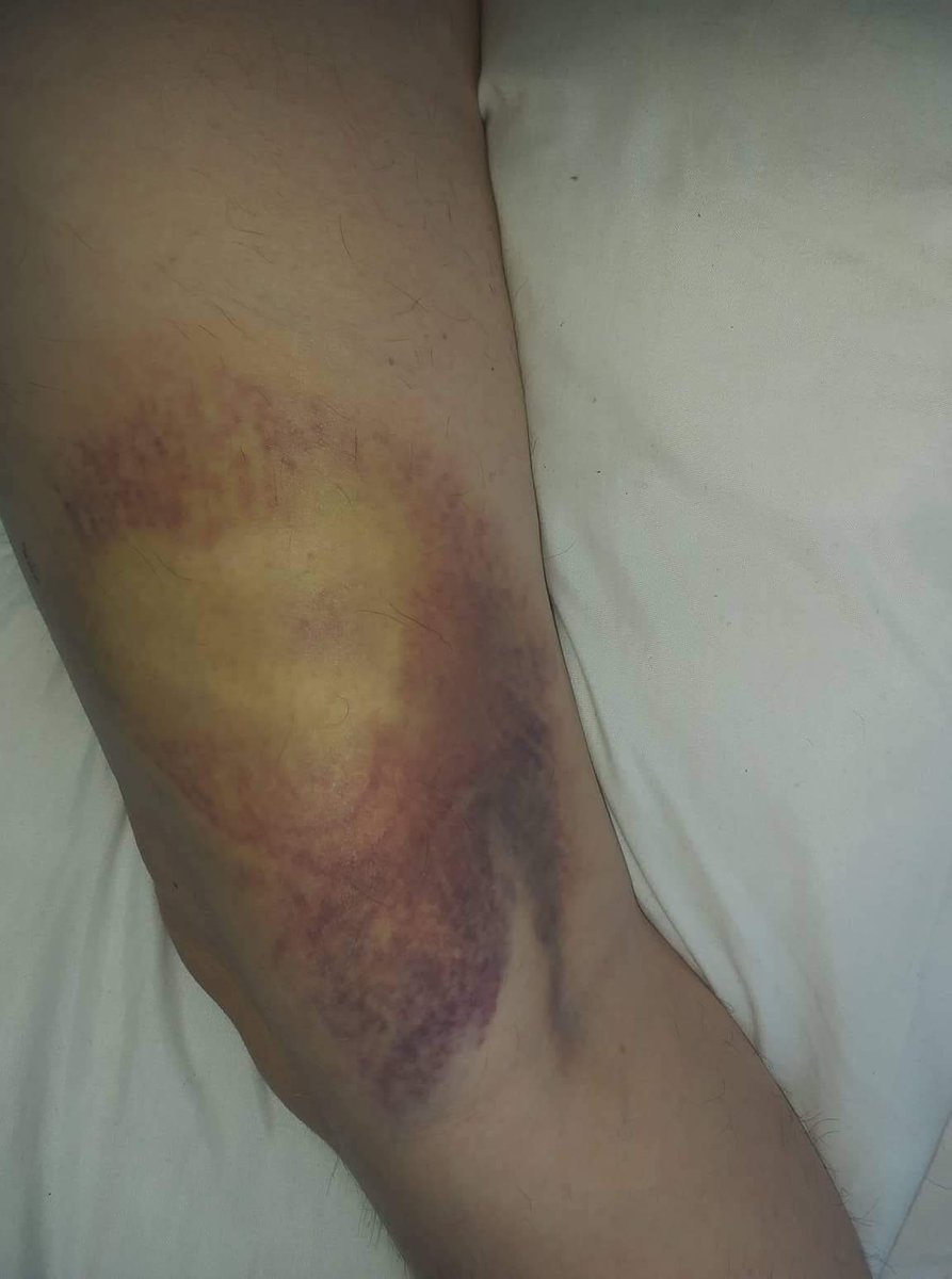 pxnk_skxes's tweet image. my mum has a bruise that looks like iron man and her only complaint is that it’s not thor @RobertDowneyJr @chrishemsworth