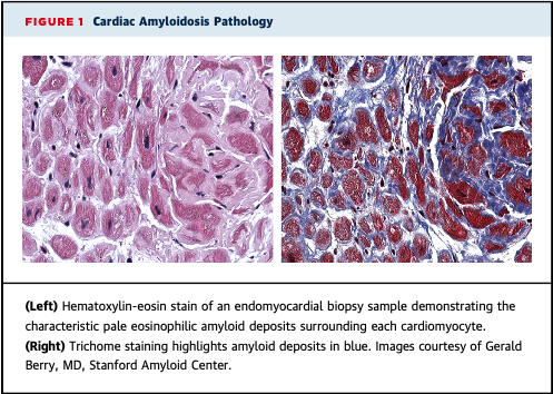Pathology: - "L" in AL amyloidosis is dominant protein depositing in AL amyloid fibrils - Clonal light chains circulate in bloodstream and can deposit in any organ - In the heart, deposition found throughout myocardium, w/ amyloid deposits surrounding each cardiomyocyte