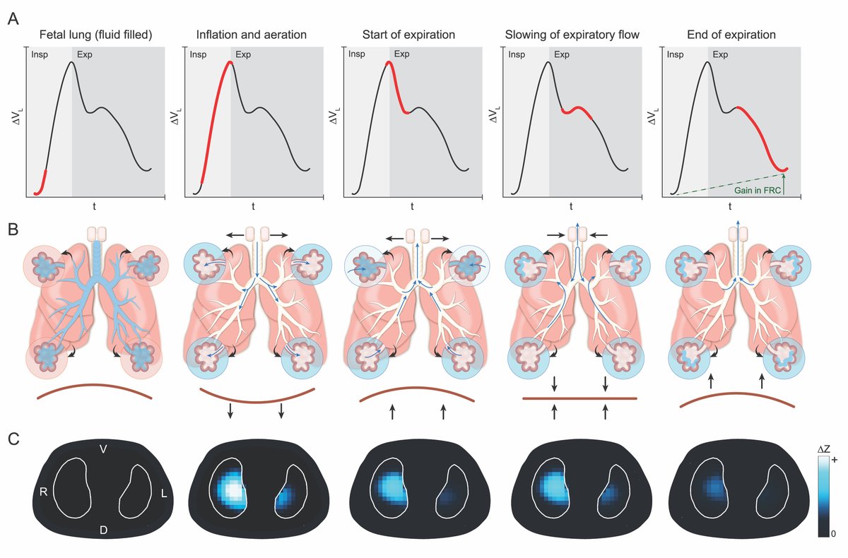 Unravelling the complexities of the first breaths of life.

New work from Neonatal Research @MCRI_for_Kids @thewomens in #AJRCCM reporting the first detailed images of the respiratory transition at birth. 

atsjournals.org/doi/abs/10.116…