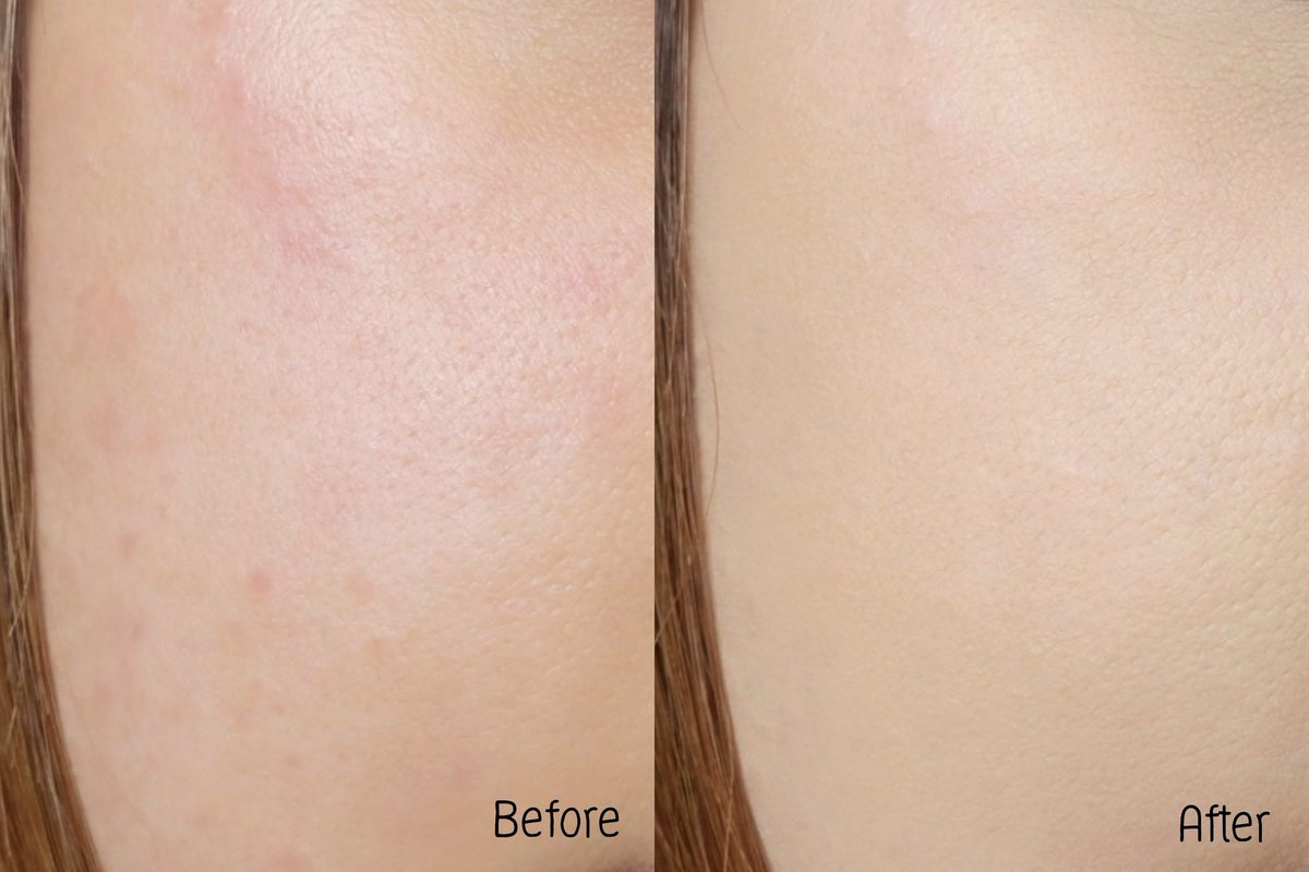 Foybeautydiary's tweet image. เห็นคนรีวิวเยอะ งานผิว Hya Matte น้องใหม่จากบ้าน Sis2Sis คือปังจริง รองพื้นเนื้อแมทเนียนแนบไปกับผิวเลย ใครไม่ชอบรองพื้นหนาๆคือตอบโจทย์ น้องปกปิดได้กลางๆนะ แนะนำให้ใช้คู่แป้งคือหน้าเป๊ะจริง ช่วยคุมมัน เบลอรูขุมขน ผิวเนียนกริบ แต่ไม่หนา มีไฮยาช่วยบำรุงผิวด้วย #งานผิวดีต้องมีไฮยา