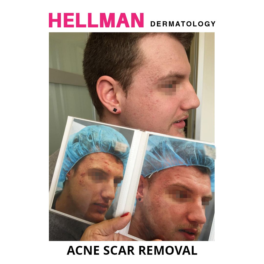 This patient had acne and acne scars we were able to remove using a combination of cutting-edge Morpheus8 (RF and microneedling) and PDL which is a laser device. Dr. Hellman gets rid of acne, fades acne scars and improves your skin complexion.
#morpheus8 #PDL