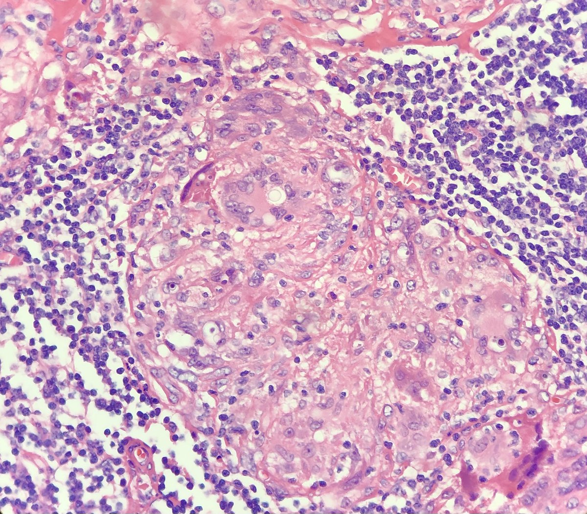 jake_bledsoe's tweet photo. Paracoccidioides lymphadenitis. Characteristic polygemulating yeast ("ship's wheel") on GMS. #hemepath #pathology https://t.co/6KgXb5un1V