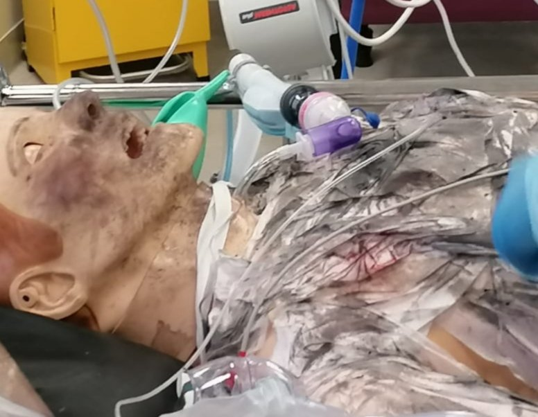 ed_tuh's tweet photo. Prehospital, ED &amp; ICU #burns #simulation training.  Anticipated #Difficult #Airway Drill, assign roles for plan ABCD &amp; prepare to do #FONA. Calculate % TBSA burned:- the mersey burns app is #free &amp; fantastic. Consider #Trauma &amp; #Toxicology inc cyanide &amp; CO. Avoid volume overload. https://t.co/uxwanLXna6