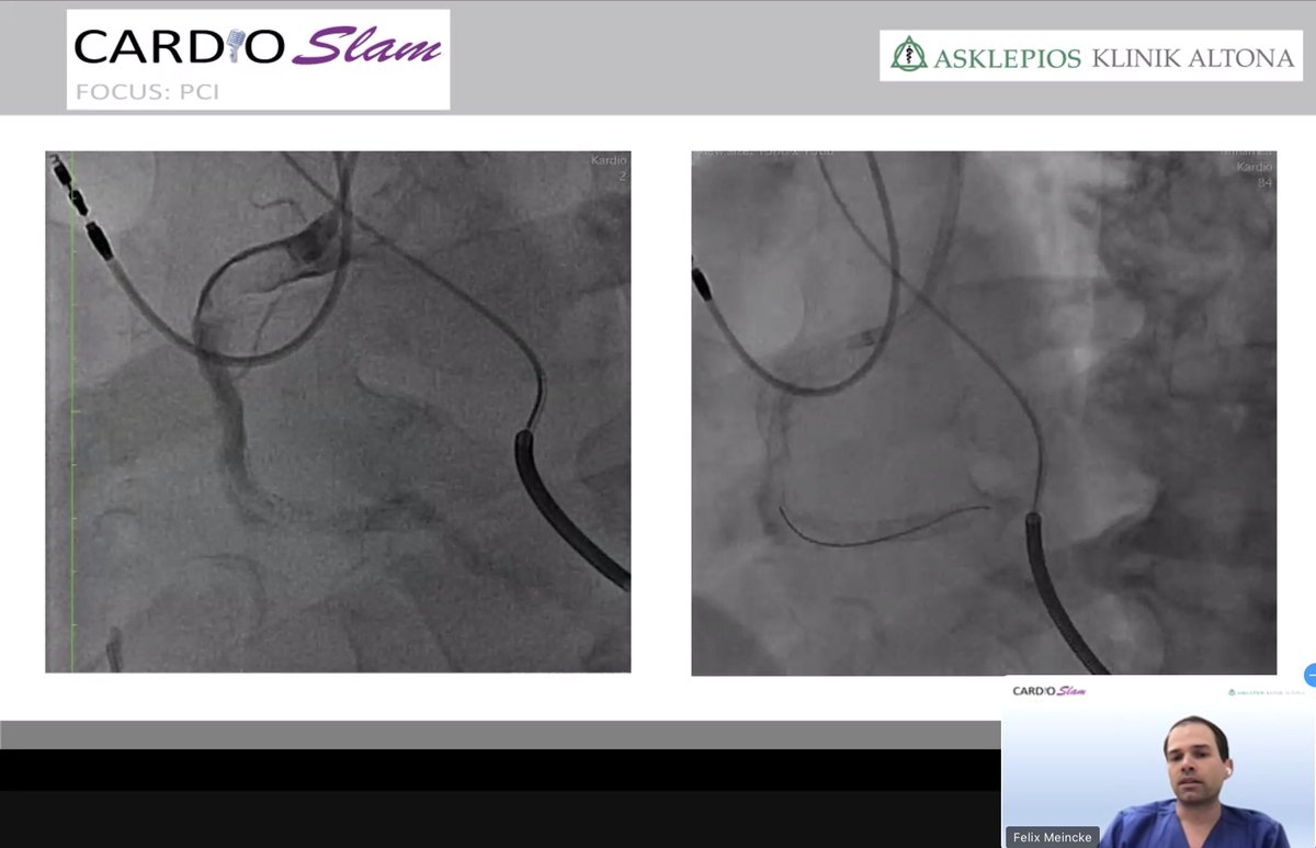 Sameh Elsaify (@samehelsaify) on Twitter photo Thrombosis... Thrombosis either in coronaries or peripheral arteries, either nativ or comlications from intervention or closure devices. Or the other side Bleeding. Nice cases in Cardioslam Hamburg, Focus PCI <a href="/sulimov_dmitry/">Dmitry Sulimov</a> Thrombosis... Thrombosis either in coronaries or peripheral arteries, either nativ or comlications from intervention or closure devices. Or the other side Bleeding. Nice cases in Cardioslam Hamburg, Focus PCI <a href="/sulimov_dmitry/">Dmitry Sulimov</a>