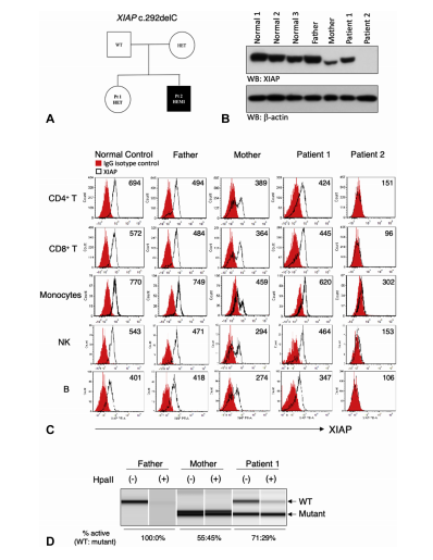 JACIInPractice's tweet photo. In Current Issue! Recurrent #lymphadenitis in a female #XIAP/ #BIRC4 #mutation #carrier with normal #lyonization https://t.co/d388zPgYBa https://t.co/RWLP9oLUWM