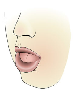 Mouth breathing and abnormal tongue position are two factors found in children with obstructive sleep apnea.They're also linked with facial growth issues.The study had limitations, like small sample size, but I'm sure the parents were happy regardless. https://www.ncbi.nlm.nih.gov/pmc/articles/PMC6092010/