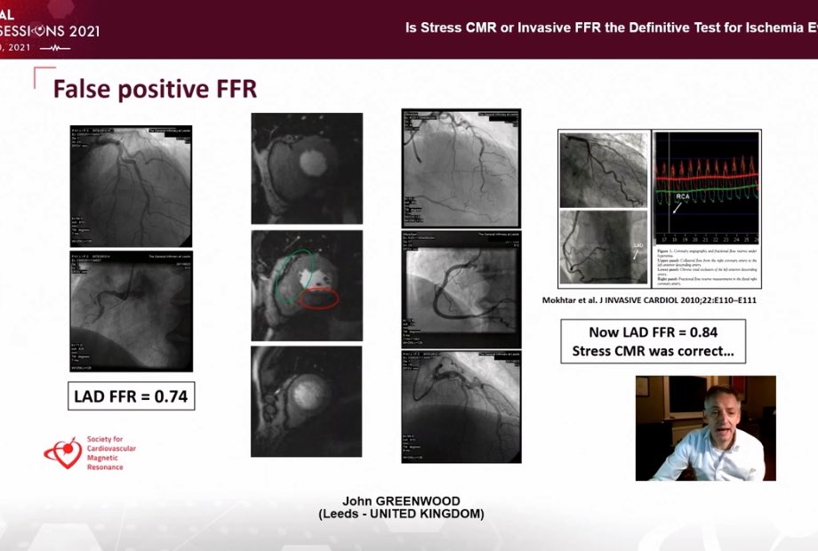  #SCMR2021  data showing CMR is as good if not better than SPECT.   #whyCMR also better with risk stratification with available prognostic data FFR - binary Stress CMR perfusion imaging with gradient of imaging severity