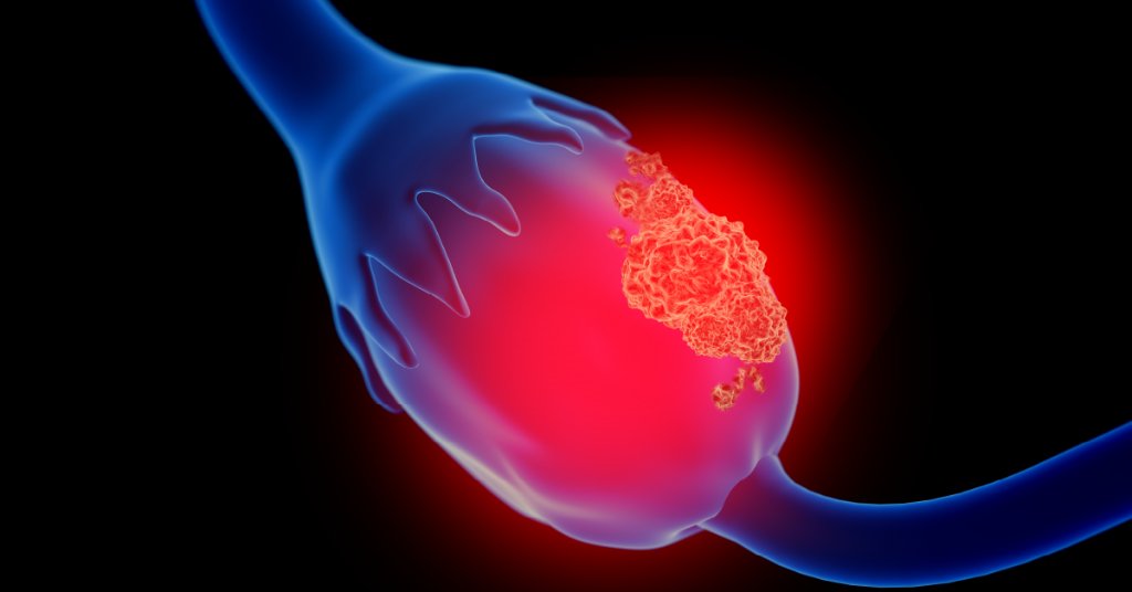 WebMD's tweet photo. Early ovarian cancer rarely has symptoms. As the disease progresses, some signs may appear -- but they can also be caused by other conditions. Here's when you should call your doctor. https://t.co/ZEQ1qdDeq9 https://t.co/ZsAbysCfOc