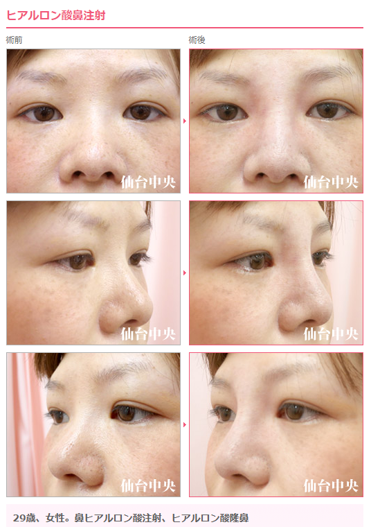 鼻を高くする Twitter Search Twitter