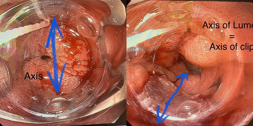 Tip #5:Unlike a band, OTSC has directionality. To avoid 1 of 4 “pillars” from obstructing the lumen, position the axis of the jaws in line with the axis of the lumen. This must be deliberately planned even before installing the OTSC.