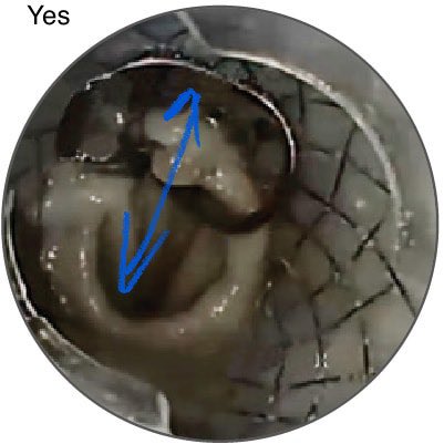 This is even more critical with the OTSC Stentfix, which is best installed vertically 6-12 o’clock. To deploy, look up and bite half the esophageal stent and half the mucosa.