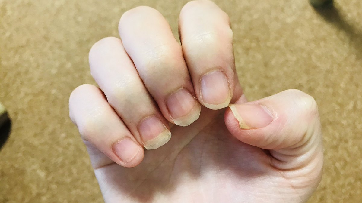 カラフル على تويتر 小指 噛んでしまった 4ヶ月我慢したのに 原因は 嫉妬 自分のなりたい姿に他の人がなっていて 羨ましくて 焦ってしまった 自然に口に手が 爪噛みをなくすにはただ癖をなおすだけじゃない 内面的な成長とか変化が必要なのかも