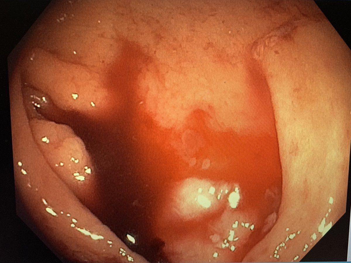 Tip #7:Banding (inverting) a bleeding diverticulum is safe, effective, and durable especially in the L colon. Mark it with a clip or tattoo (+Epi), install bander, and suction to invert and band!  https://www.jwatch.org/na44984/2017/09/07/band-ligation-shown-most-effective-therapy-colonic
