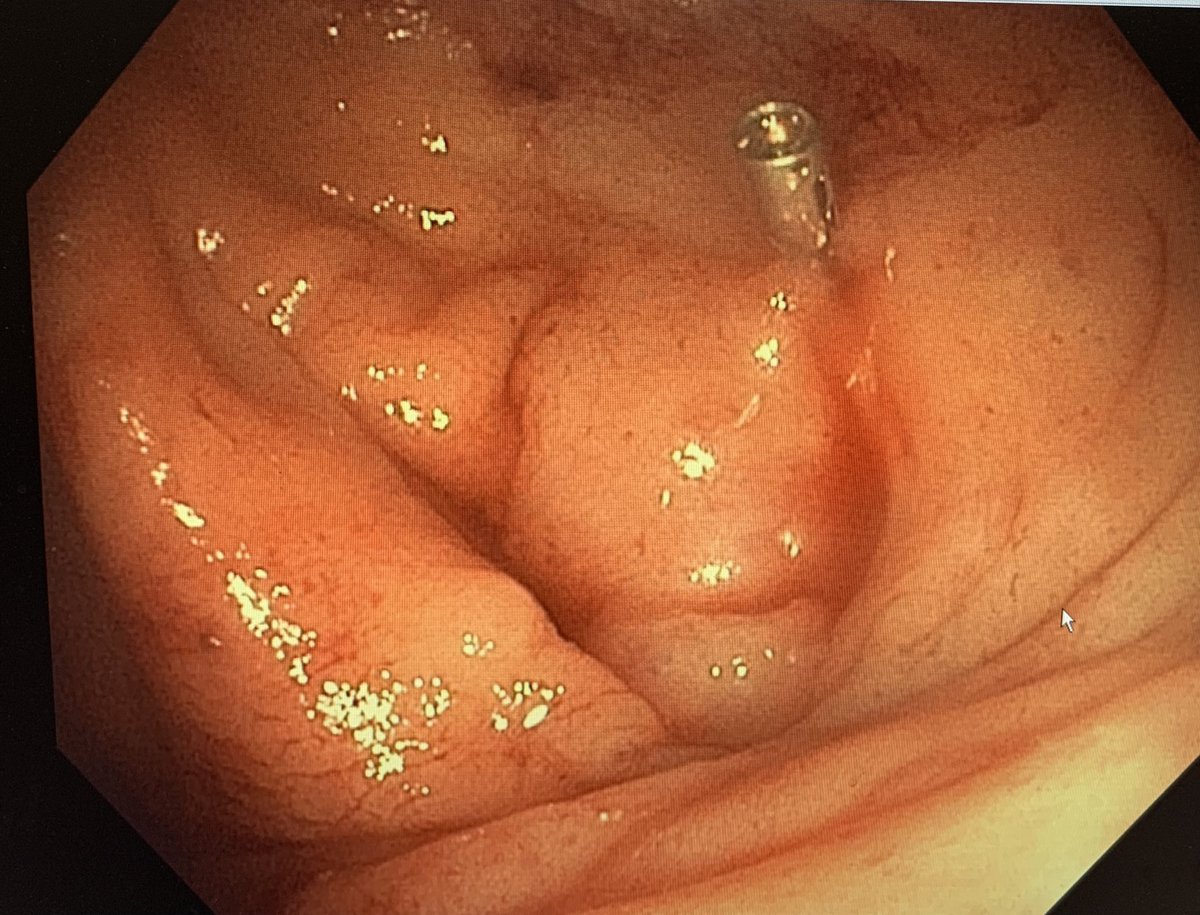 Tip #7:Banding (inverting) a bleeding diverticulum is safe, effective, and durable especially in the L colon. Mark it with a clip or tattoo (+Epi), install bander, and suction to invert and band!  https://www.jwatch.org/na44984/2017/09/07/band-ligation-shown-most-effective-therapy-colonic