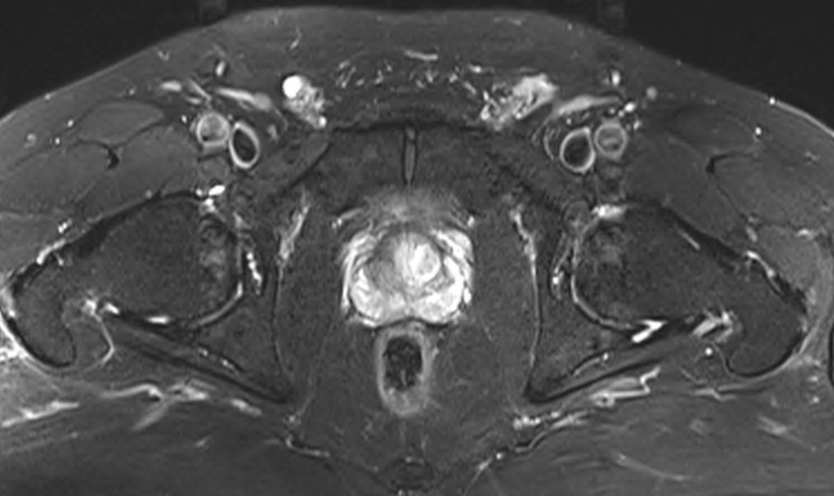 4. mri symphysis oblique axial views (& sagittal) normal - no pubic stress, conjoint tendon, add origin pathology etc