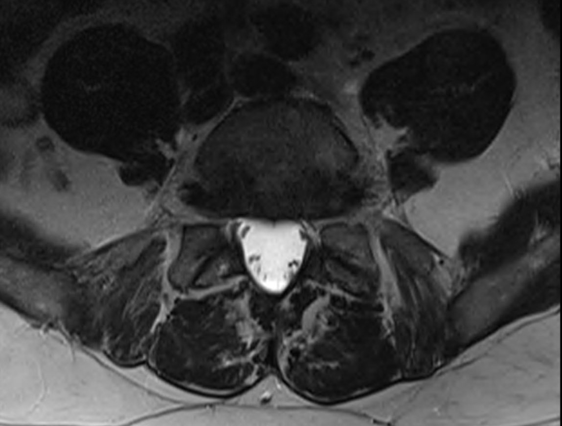 6. request mri LSp - spondylolisthesis L5/S1 and facet hypertrophy causing nerve root compression (bilateral!), associated disc Modic 1 changes