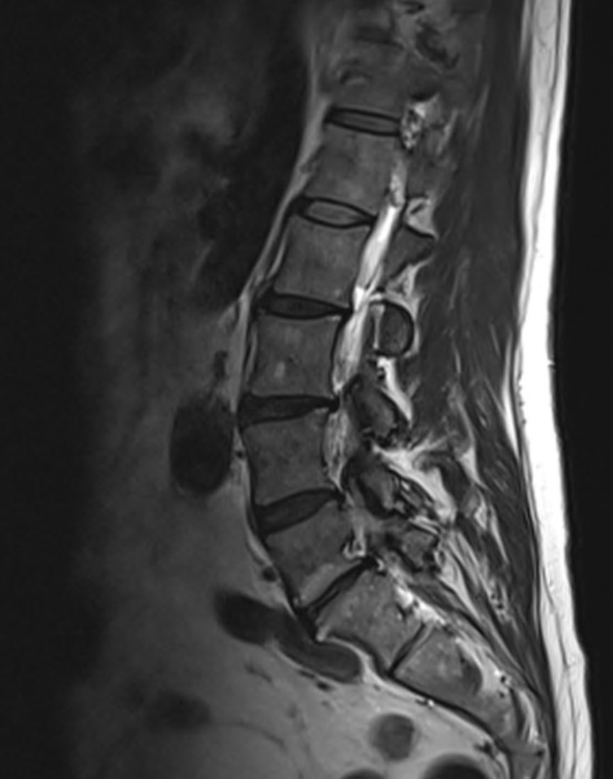 6. request mri LSp - spondylolisthesis L5/S1 and facet hypertrophy causing nerve root compression (bilateral!), associated disc Modic 1 changes