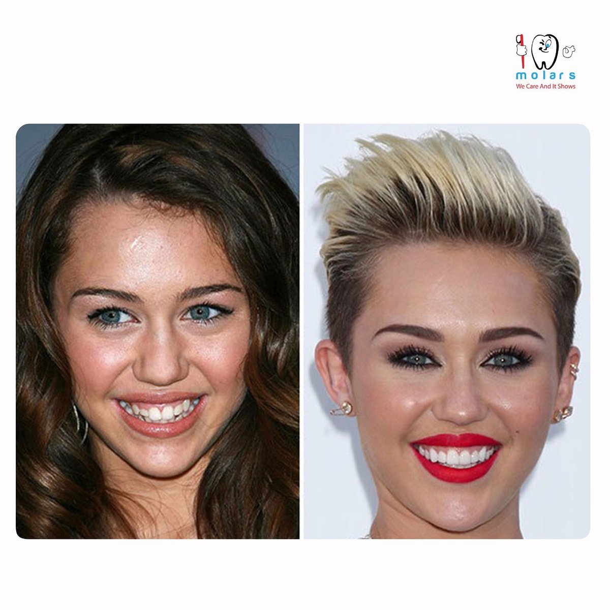 Miley Cyrus Teeth Before And After