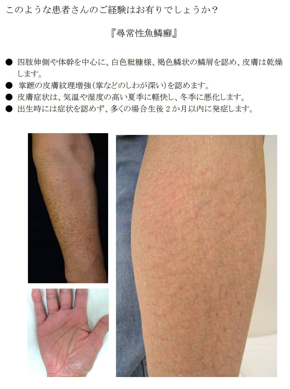 やさひふ クラファン中 Lumedia編集長 皮膚科専門医 医学博士 Sur Twitter 鮫肌と鳥肌 皮膚科的には 鮫肌 魚鱗癬 魚の鱗的に皮膚が硬くなる 毛孔性苔癬 ケラチナミンなど尿素クリーム 鳥肌 アトピックドライスキン アトピー等でガサガサ ヒルドイド