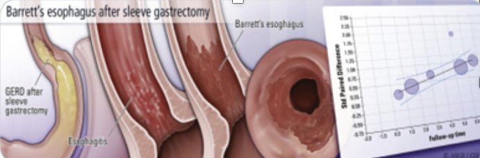cjmedicaluk's tweet photo. New Research Demonstrates Reflux and Barretts Esophagus is a growing problem due to de novo GORD after sleeve Gastrectomies. Learn more by clicking the below article link:

https://t.co/Qs69FTsUeD https://t.co/0PmDEArz4c
