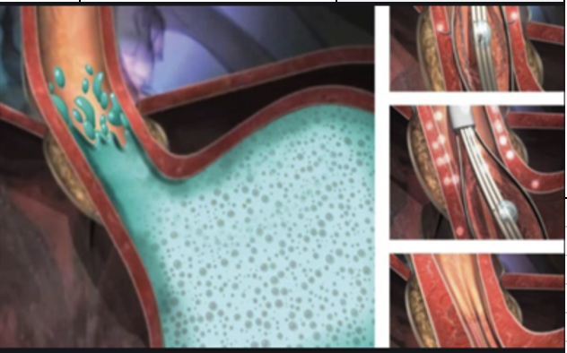 cjmedicaluk's tweet photo. The Stretta® procedure is a safe and effective treatment option for patients who suffer with Gastro-Oesophageal Reflux Disease (GORD). See link Below for more information #stretta #acidreflux #GORD #treatment 

https://t.co/CNLi5Y11x1 https://t.co/V7RObasRCG