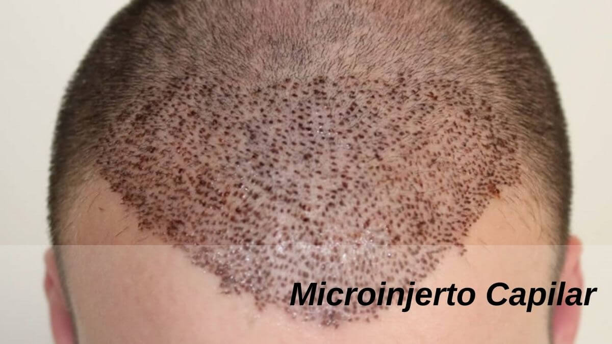 ClinicsEuro's tweet photo. El microinjerto capilar es el mismo que la técnica FUE estándar. Los instrumentos que se utilizan para tomar injertos de la zona donante son diferentes.
#microinjertocapilarentradas #microinjertocapilar #microinjerto

https://t.co/TpgPRNAmPU https://t.co/QqRdqzcl5C