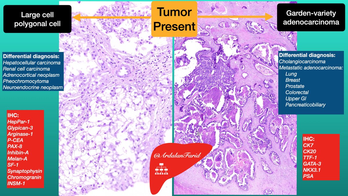 ArdalanFarid's tweet photo. An algorithmic approach to liver mass. All comments and suggestions are welcome.
#PathTwitter 
#Liverpath
#GIpath
#TUMSpath https://t.co/D5fAeoXO6s