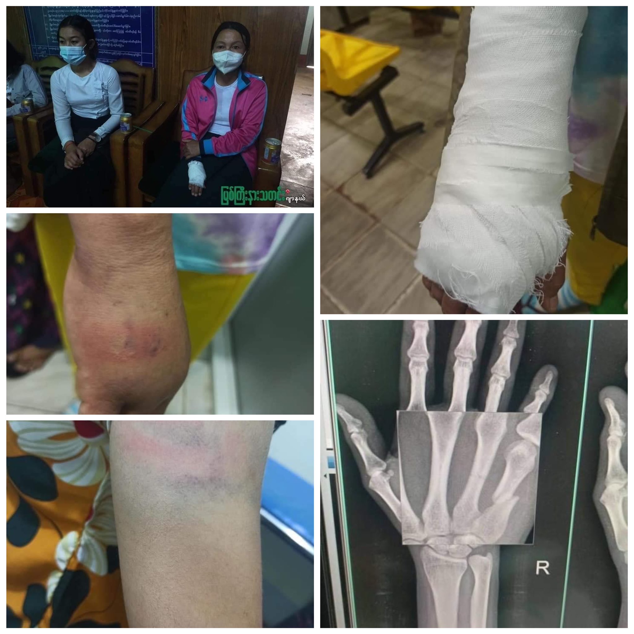 Myat Su Khin 今朝カチン州のミッチーナー 町で拘留された教師二人は今日中に釈放されました 二人共警察に警棒で殴打され 一人は手を強く痛め 骨折しました 国軍は次々と国民に暴力を振るっている Myat Su Khin 今朝カチン州のミッチーナー 町で拘留された教師二人は今日中に釈放されました 二人共警察に警棒で殴打され 一人は手を強く痛め 骨折しました 国軍は次々と国民に暴力を振るっている
