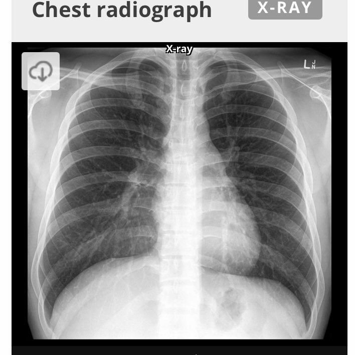 This is a normal chest X ray. The black things on either side are the lungs filled with air. White round thing in the middle is the heart. Lines across are the ribs. The lungs are well expanded.