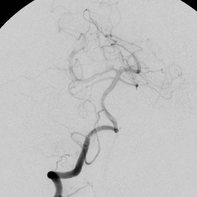 Impressive images <a href="/SynaptiveMed/">Synaptive Medical</a> Modus V Exoscope to treat a tentorial dAVF fed from the right SCA into large arterialized cortical vein. Prone intra-op angio from right radial approach <a href="/InovaHealth/">Inova</a> .  #cerebrovascular <a href="/NeurosurgeryCNS/">Neurosurgery Publications</a> <a href="/TheJNS/">Journal of Neurosurgery</a> <a href="/EdGreenbergMD/">Edward Greenberg, MD</a> <a href="/fortesmd/">Dr. Manuel Fortes</a>