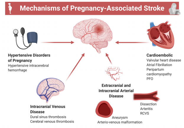 CircAHA's tweet photo. #InDepthReview: #Maternalstroke: A call for action https://t.co/PxpGovPJaX #GoRedforWomen #AHAJournals @islamelgendy83 @WCMQatar @WCMQresearch https://t.co/yU32B52CFq