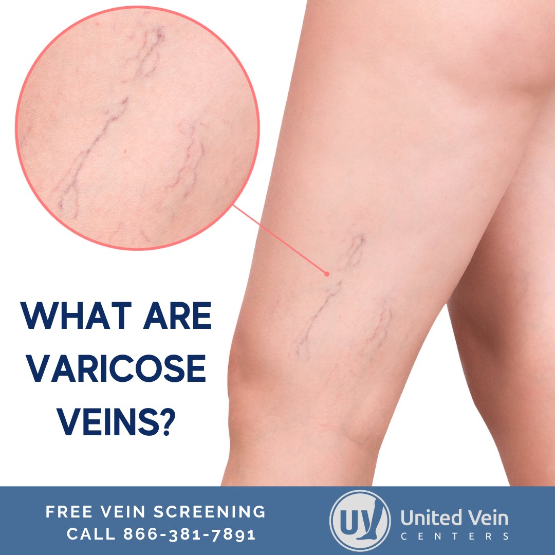 Varicose veins can cause pain, aches, throbbing and swelling in the legs. Don't live in discomfort, call United Vein Centers for a free vein screening today!

📞 866-381-7891
UnitedVeinCenters.com
#UnitedVeinCenters #VeinClinic #VeinDoctor #VaricoseVeinTreatment #VaricoseVeins