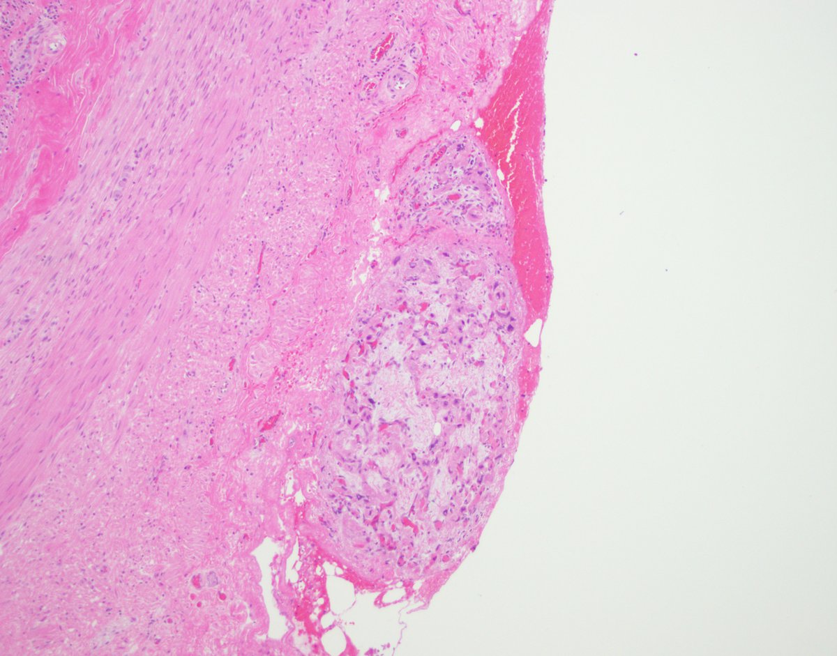 stephen_lagana's tweet photo. Just a normal boring appendix? But what's happening in the lower right?? Any questions you'd like answered before venturing a dx? #pathology #GIpath https://t.co/02McBRsKvs
