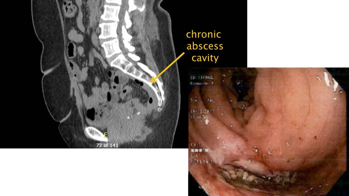 DCRjournal (@dcrjournal) on Twitter photo Transanal minimally invasive surgery: an effective approach for patients who require redo pelvic surgery for anastomotic failure by <a href="/suziehillmd/">suziehillmd</a> <a href="/justinmaykel/">Justin Maykel</a> <a href="/UMASSColorectal/">UMASS Colorectal Surgery</a> @fascrs_updates - bit.ly/3u4ujZB
What do you think about this article? #ColorectalResearch Transanal minimally invasive surgery: an effective approach for patients who require redo pelvic surgery for anastomotic failure by <a href="/suziehillmd/">suziehillmd</a> <a href="/justinmaykel/">Justin Maykel</a> <a href="/UMASSColorectal/">UMASS Colorectal Surgery</a> @fascrs_updates - bit.ly/3u4ujZB
What do you think about this article? #ColorectalResearch